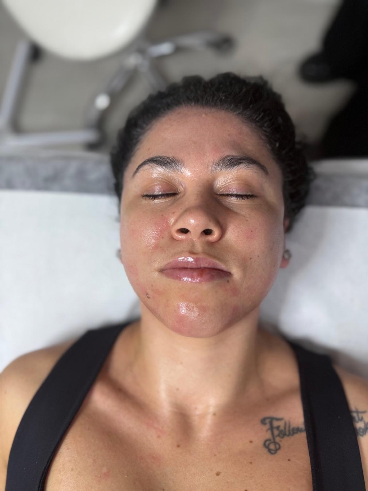 Recuperare din acnee — finalizare tratament, ten calm